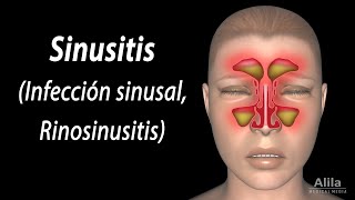 Sinusitis Animación Alila Medical Media Español [upl. by Eitisahc519]