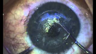 Clinical testing extraocular muscles tutorial [upl. by Hilbert215]