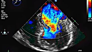 Echocardiographic assessment of the mitral valve [upl. by Esilram]