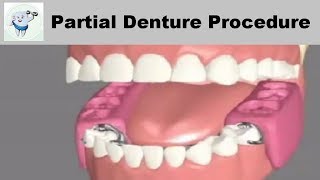 Removable Partial Dentures Steps [upl. by Seuqram334]