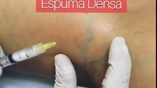 Tratamento de Varizes com Espuma Densa [upl. by Ahsam]