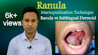 Mucocele and Ranula Oral Pathology  Dental Classes by DrAthira [upl. by Ynnig]