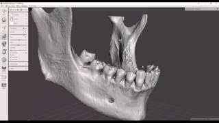 Convert Dicom CT to STL file 3D printable [upl. by Inaj]