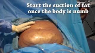 How is liposuction performed  Centre for Surgery [upl. by Ervin379]