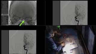 A Revolution in Stroke Care Thrombectomy [upl. by Brock]