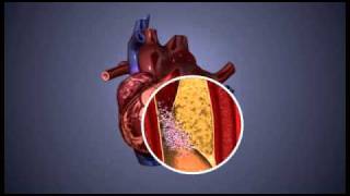 Atherosclerosis  3D Animation  ABP © [upl. by Eico]