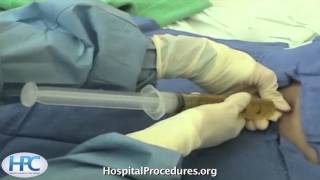 Paracentesis Procedure Video Trailer [upl. by Carlynn857]