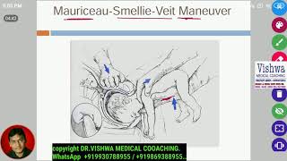 Mauriceau smellie veit maneuver for breech presentation BY DRVISHWA MEDICAL WHATSAPP 919930788955 [upl. by Aibonez]