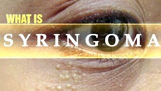 What is Syringoma  Usapang Pangkalusugan [upl. by Ponzo]