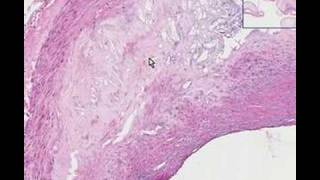 Histopathology Coronary arteriesAtherosclerosis [upl. by Namwob]