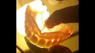 Russell Klein Horseshoe Denture [upl. by Paymar]