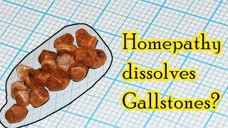 Can homeopathic medicine dissolve gallstones  Dr Sanjay Panicker [upl. by Etnauq]