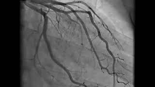 Coronary Angiography  NEJM [upl. by Linder]