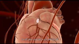 Percutaneous Coronary Intervention PCI [upl. by Anayhd915]