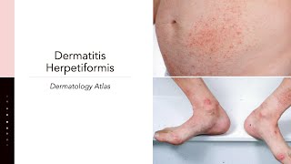 Dermatitis Herpetiformis [upl. by Furie]