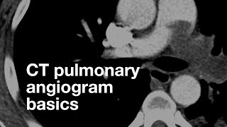 Pulmonary CT Angiogram Basics [upl. by Delcina426]