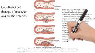 Atherosclerosis  Causes Pathogenesis Prevention [upl. by Etteyafal]