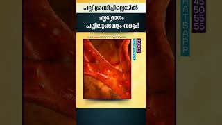 പല്ല് ശ്രദ്ധിച്ചില്ലെങ്കിൽ ഹൃദ്രോഗം പല്ലിലൂടെയും വരും [upl. by Aniv]