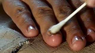 How to Cure Nail Fungus [upl. by Tannenwald959]