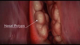 Nasal Polyps diagnosis and treatment options [upl. by Eisen]