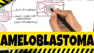 Ameloblastoma  Origination Clinical Radiographic amp Histopathologic features [upl. by Faustus95]