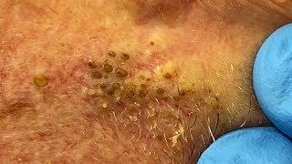 Extremely Clogged Pores Extracted  Contour Dermatology [upl. by Annayad199]