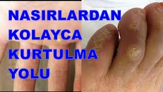 El Ayak Nasırlarından Kolayca Kurtulabileceğinizi BİLİYOR MUYDUNUZ [upl. by Yelsha]