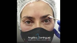 Blefaroplastia Sin Cirugía  Dr Angélica Domínguez Dermatóloga en bogotá [upl. by Foulk]