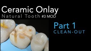 Lithium Disilicate Ceramics Part 1 Ceramic Onlay CleanOut 3 MOD [upl. by Winter883]