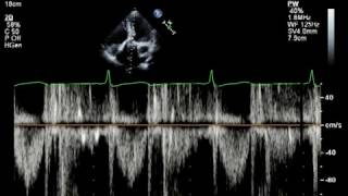 Echo Challenge Mitral Regurgitation [upl. by Casabonne]