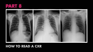 Diaphragms and Pleural Effusion  How to Read a Chest XRay Part 8  MEDZCOOL [upl. by Ambrogio]