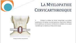 La Myélopathie Cervicathrosique Cervicarthrosis Myelopathy SFCR [upl. by Tneicniv532]