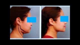 Sculpt the Chin amp Neck With Liposuction  Dr Sterry Explains [upl. by Aldric]