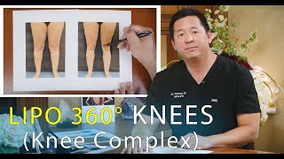 Virtual Consultation  Lipo 360 Knees  Leg Liposuction  Lipedema Surgery  Artlipo  Expert Dr Su [upl. by Nay413]