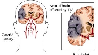 Stroke Prevention amp Transient Ischemic Attack TIA [upl. by Ahtikal]