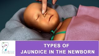 How to prevent Jaundice in newborns [upl. by Nicholson]