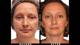 Dr Rads Brow and Forehead Lift Techniques  Plastic Surgery DC [upl. by Azeel716]