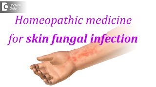 Homeopathic medicine for skin fungal infection  Dr Surekha Tiwari [upl. by Ancier]