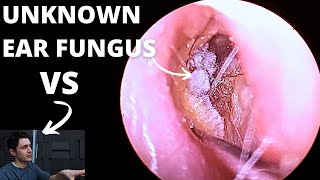 Ear Fungal Infection VS Audiologist [upl. by Hum]