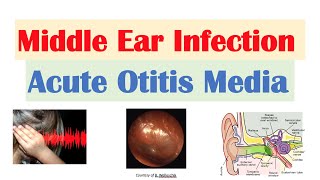 Middle Ear Infection Acute Otitis Media  Causes Symptoms Diagnosis Treatment [upl. by Symons]