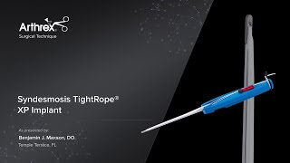 Syndesmosis TightRope® XP Implant [upl. by Parris]