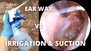 Water Irrigation And Suction Used To Clear Ear Wax [upl. by Kerns687]