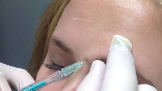 Botox for Nose  Nasal Tip Lift  San Diego Botox Injections [upl. by Asiek]