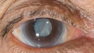 New eye drops may help treat cataracts [upl. by Anileba42]