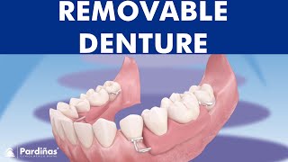 Removable partial denture © [upl. by Sauveur]