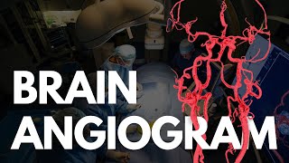 Angiography Procedure by Dr Siddhant Jain Indore [upl. by Olenta]