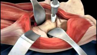 Hip replacement surgery techniques  Dr Scott Devinney [upl. by Ettenoitna490]