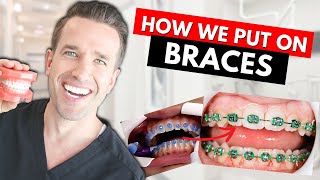 How Braces are Put On  Part IV Dr Nate [upl. by Aloap]