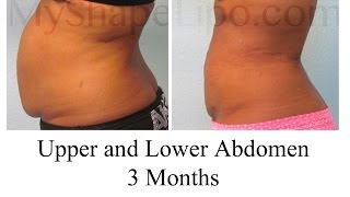 Do I Need Liposuction or Tummy tuck MyShape Lipos Trevor Schmidt PAC Reviews [upl. by Nosam819]