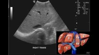 Introduction to the interpretation of Abdominal Ultrasound [upl. by Lederer]